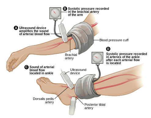 Ankle brachial index